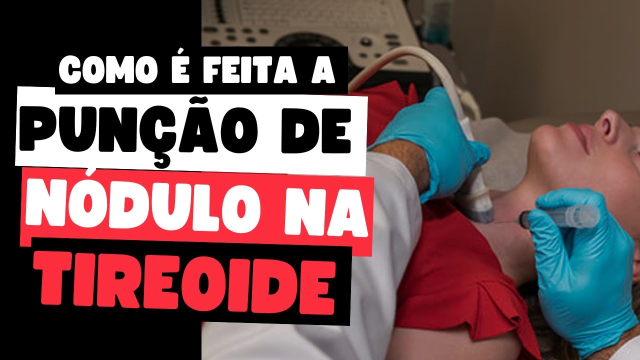 Como é feita a PAAF: entenda o procedimento e a importância para diagnóstico da tireoide