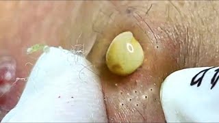 Limpeza de pele | Espinhas Gigantes | Muito Satisfatório 🤗