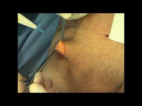 Se il photoepilation da posti di pigmentary aiuterà Macchia scura su una faccia dopo abbronzatura