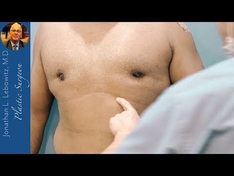 download lagu mp3 mp4 Botched Gynecomastia Surgery, download lagu Botched Gynecomastia Surgery gratis, unduh video klip Botched Gynecomastia Surgery