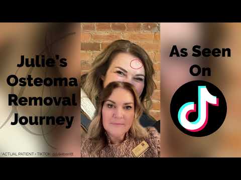 Osteoma Removal - Julie's Story | Anil Shah MD