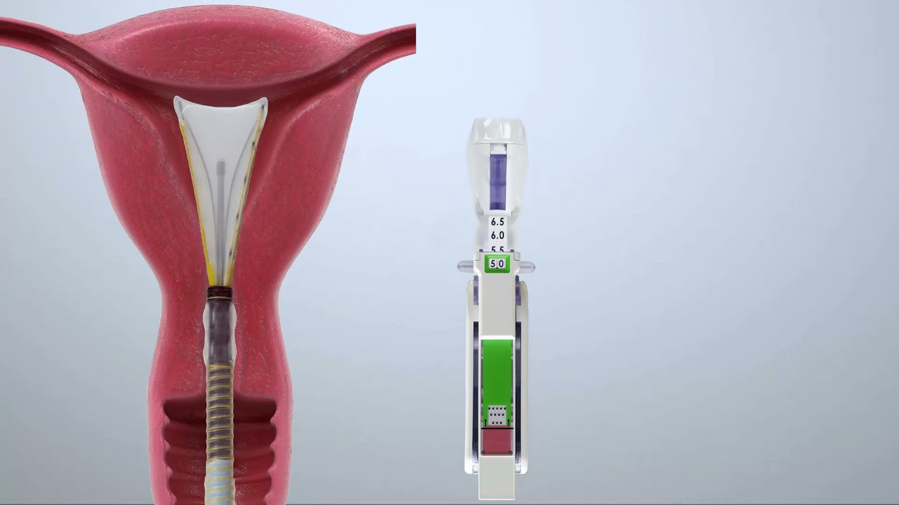 Minerva ES Treatment Step-by-Step Animation