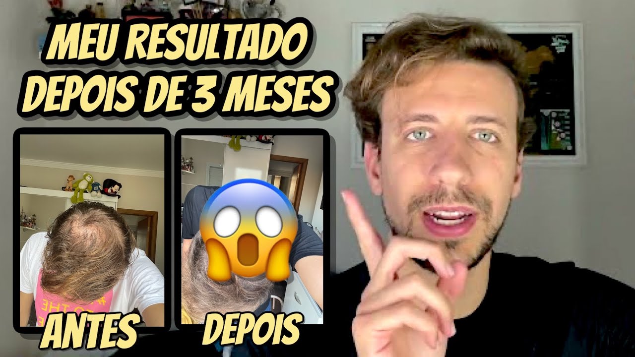 TESTEI o TRATAMENTO de QUEDA DE CABELO da MANUAL | FUNCIONA MESMO pra HOMENS e CALVÍCIE MASCULINA?
