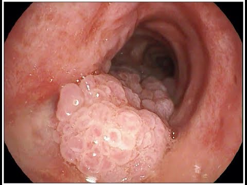 Papilloma torokdaganat, Ezért fontos a szájüregi HPV szűrés!