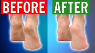 How To Fix Cracked Heels Permanently in 2024