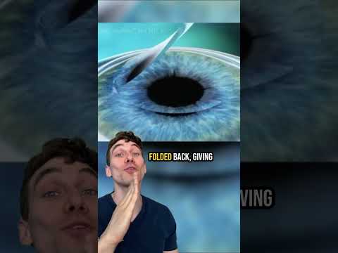 How LASIK Eye Surgery Works