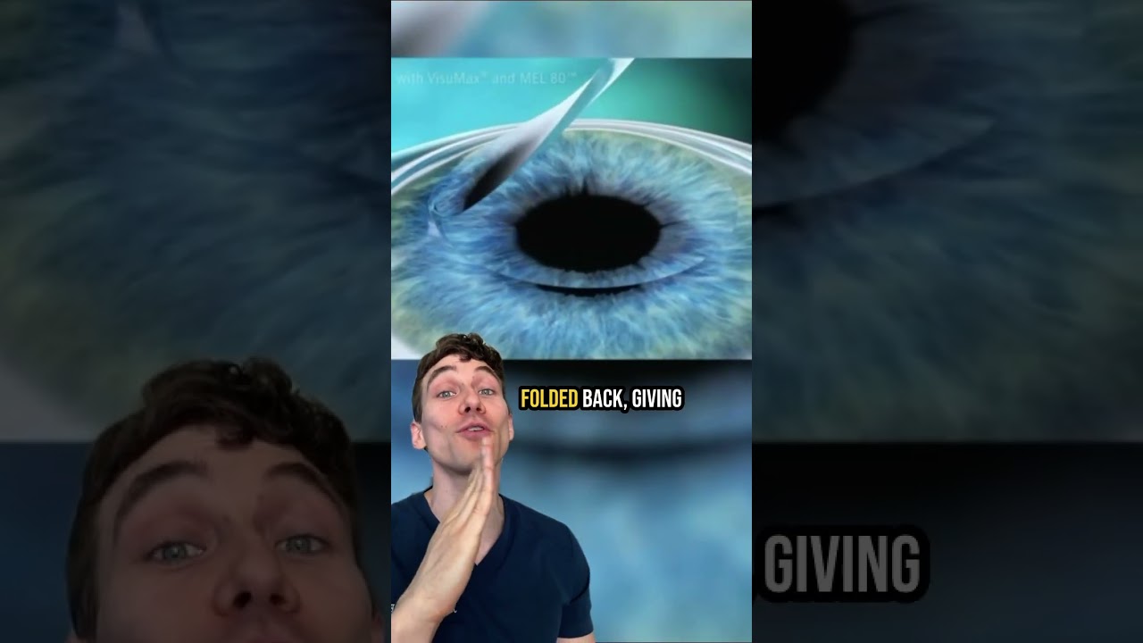 How LASIK Eye Surgery Works