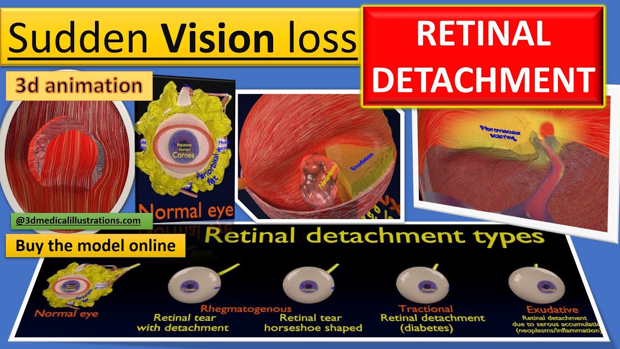 Retinal detachment types eye 3D Model