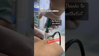 Download lagu Injection makes operation painless ? How Surgery be painless by anaesthesia ? TAP BLOCK b4 surgery mp3 Download lagu Injection makes operation painless ? How Surgery be painless by anaesthesia ? TAP BLOCK b4 surgery mp3