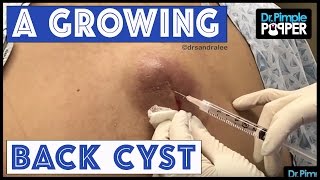 Inflamed Cyst Waterfall on the Back with Dr Pimple Popper