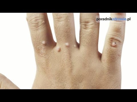 Koślawe zniekształcenie w nogę dorosłych Łapę psa między palcami zderzyć ze zdjęciami