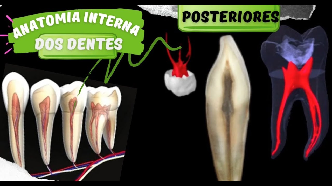 Anatomia Interna dos Dentes Posteriores (ENDODONTIA)