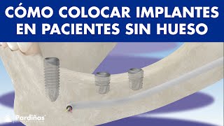 12 soluciones de IMPLANTE DENTAL para pacientes SIN HUESO © - Clínica Dental Pardiñas