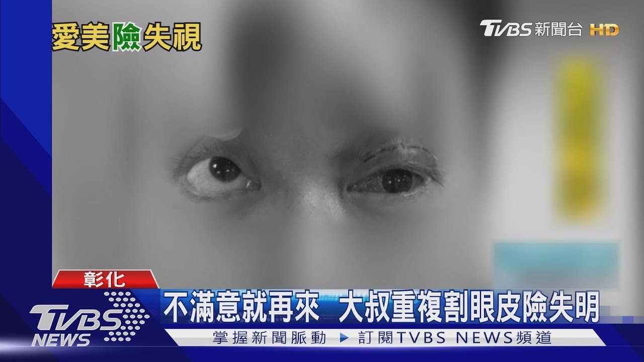 嚮往朱一龍「卡姿蘭大眼睛」 重複割眼皮險失明