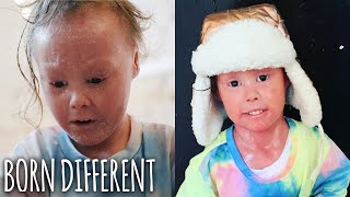 Download lagu The Girl Whose Skin Grows Too Fast | BORN DIFFERENT mp3