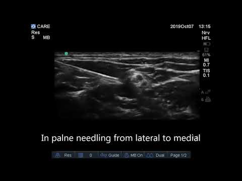 Superior Trunk block