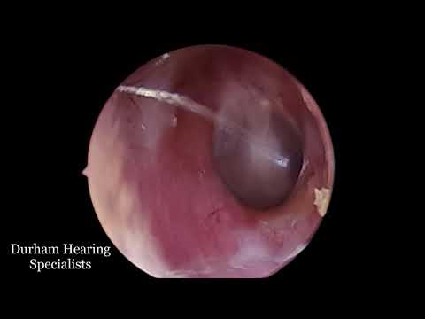 Jobson Horne (curette) used to loosen wax before suction