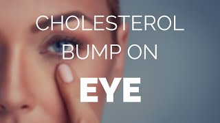 Cholesterol bump on eye, how to get rid of it !!