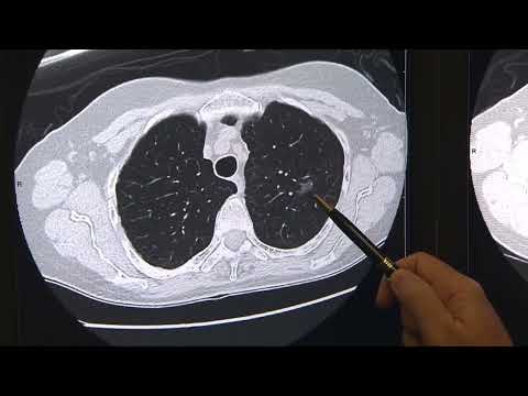 American Lung Association