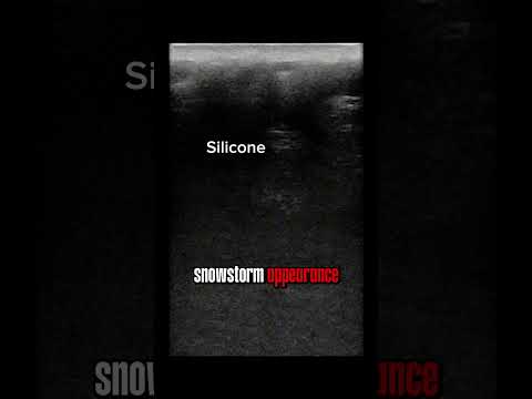 The Invisible Risk: How Facial Ultrasound Revealed 10-Year-Old Hidden Silicone