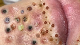 Loan Nguyen Acne Treatment 3m