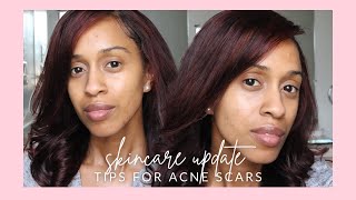 Skincare tips for acne scars | 3 month update | Kelsley Nicole