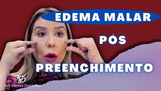 Edema malar pós preenchimento facial. Causas e consequências