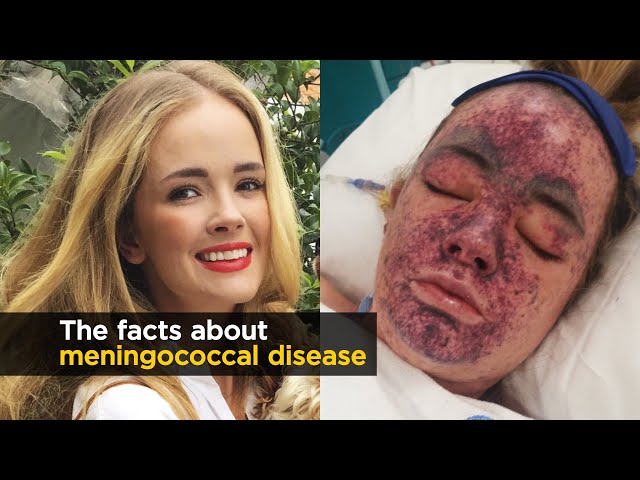 İngilizce'de meningococcal Video Telaffuz
