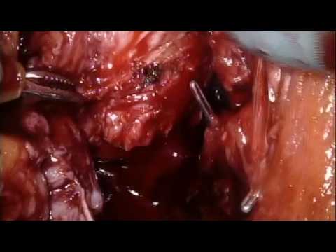 RS-RARP part 5 Lateral Prostate Dissection