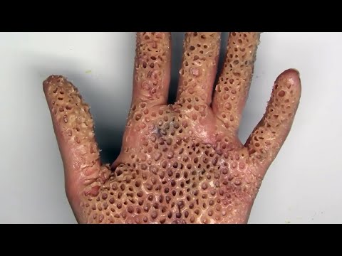 TRYPOPHOBIA ALERT! Killer Insect Destroys Hand; Is It Real? Video
