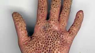 TRYPOPHOBIA ALERT! Killer Insect Destroys Hand; Is It Real?
