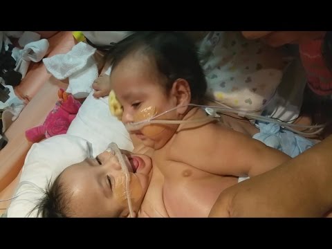 Conjoined Twins Undergo Complicated Separation Surgery Video