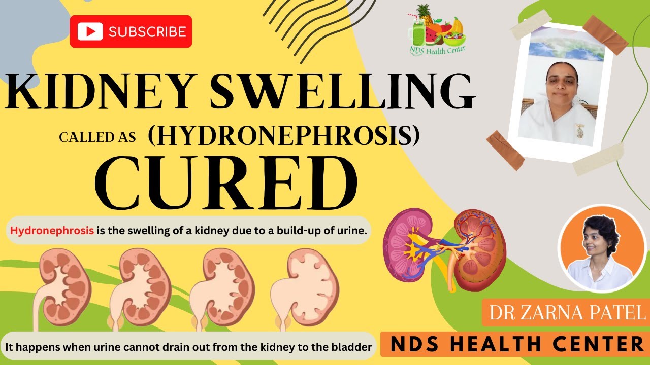 Hydronephrosis (kidney Swelling) Healed in 2 Days By Dr. Zarna Patel (NDS) | New Diet System