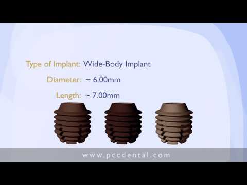 Ask Gordon:  What is a small-diameter implant?