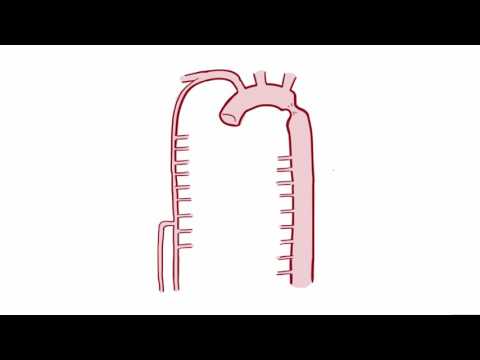 Coarctation of the Aorta CoA repair, causes, symptoms & pathology