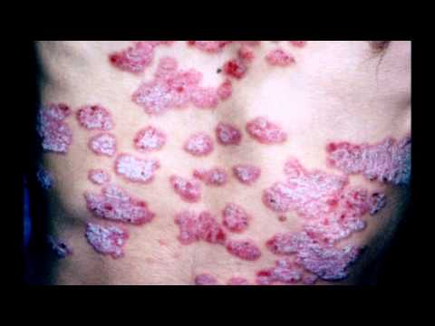 The Pain of Psoriasis.....Sixx A.M. - Skin