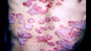 The Pain of Psoriasis.....Sixx A.M. - Skin