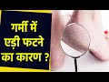 गर्मी में एड़ी फटने का कारण Garmi Me Edi Fatne Ka Karan 
