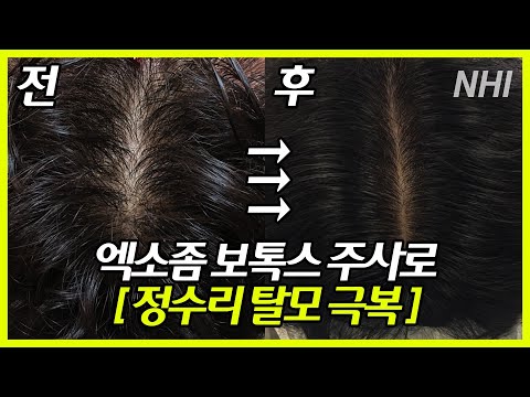 엑소좀, 보톡스 탈모치료로 정수리 탈모 극복!｜뉴헤어