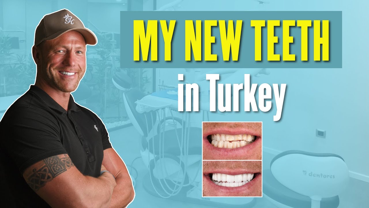 Smile Makeover: NEW Teeth in Turkey at Dentares Smile Clinic!