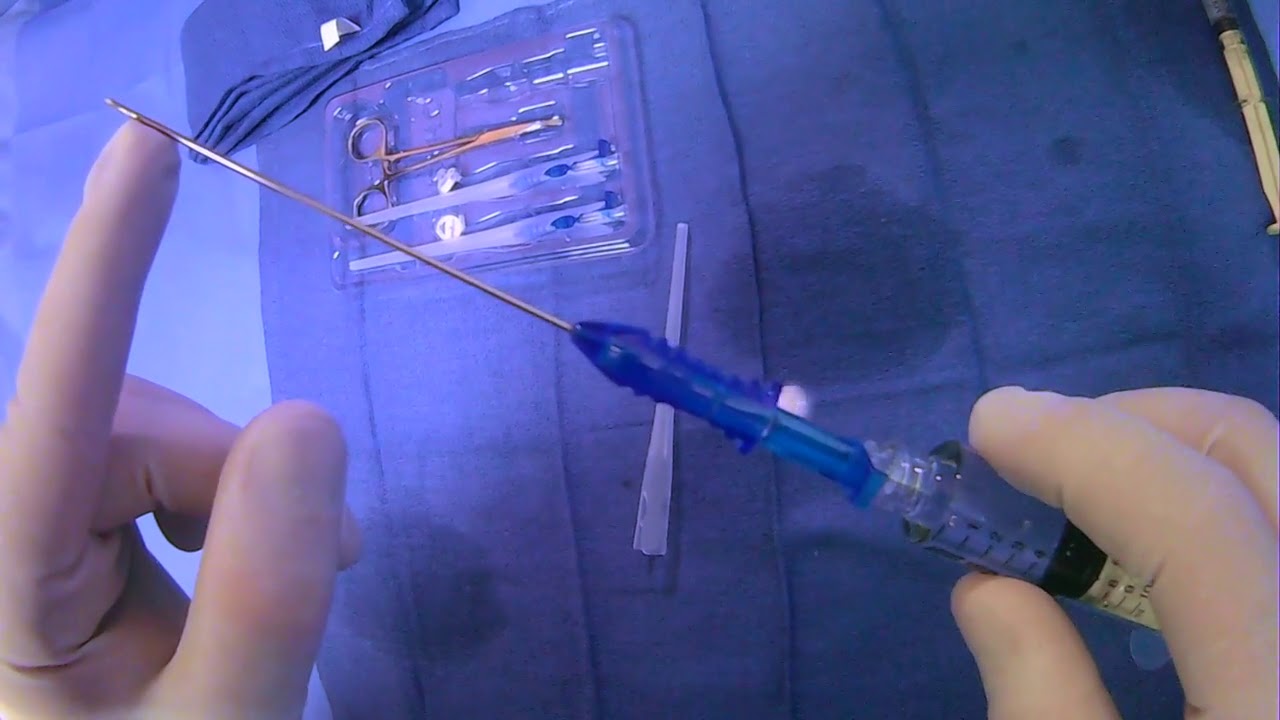 Watch video Gastrointestinal Anchor Set (T-Fasteners/T-Pexy Devices) Now Gastrointestinal Anchor Set (T-Fasteners/T-Pexy Devices)