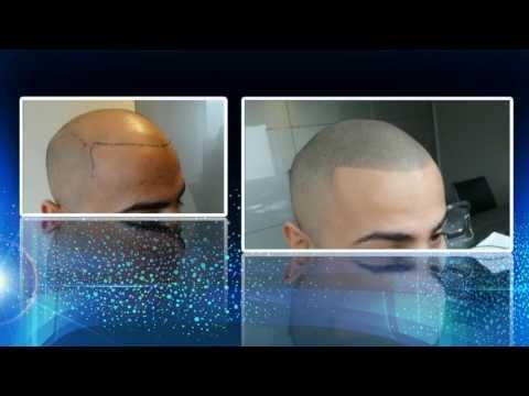 Decolorazione di capelli della persona con perossido di idrogeno A causa del quale i posti di pigmentary su una faccia sono formati