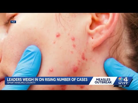 Measles outbreak in South Carolina tops 700 cases; leaders speak on the outbreak
