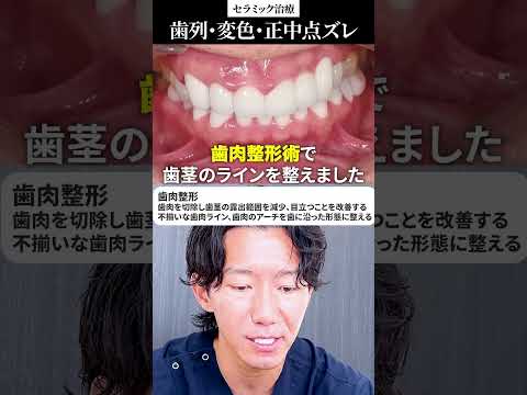 【50代男性】欠けた歯をセラミック治療！自慢の白い歯で自信を取り戻す！！