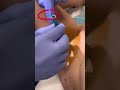 The FULL POP of this amazing abscess | 208SkinDoc