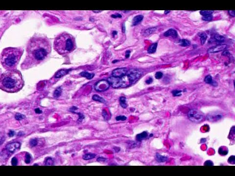Canine Distemper Pneumonia