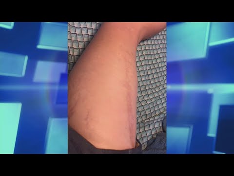 How to Best Treat Old Scars