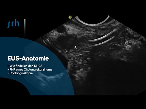 EUS-Anatomie: wie finde ich DHC? Nachfolgend mit FNP eines Cholangiokarzinoms, Cholangioskopie