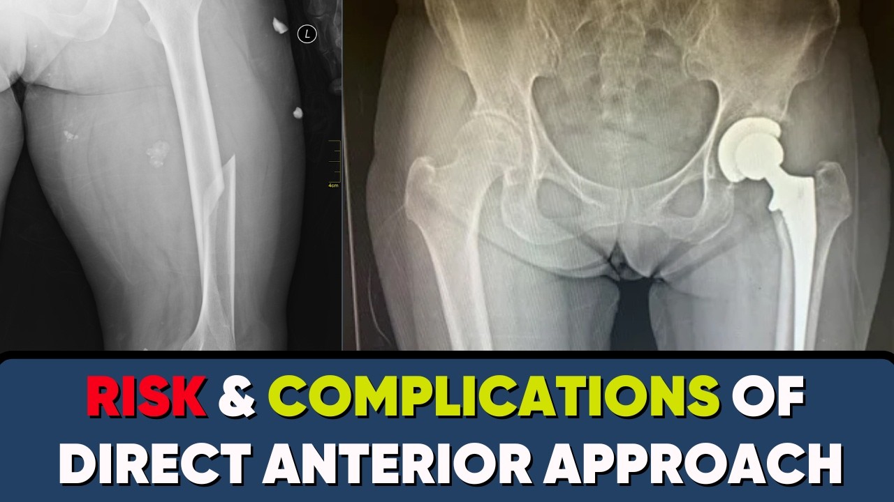 WHAT RISK OF TOTAL HIP REPLACEMENT? #DirectAnteriorApproach (2025 UPDATED)