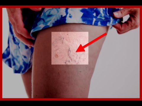 Masajul picioarelor este sigur pentru varice, care pot fi contraindicațiile?